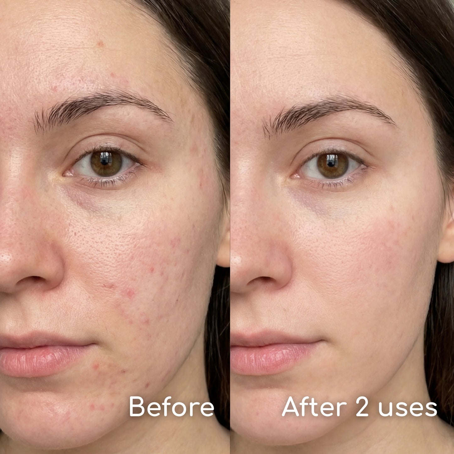 Clear Patch - Full Face Pimple Patch